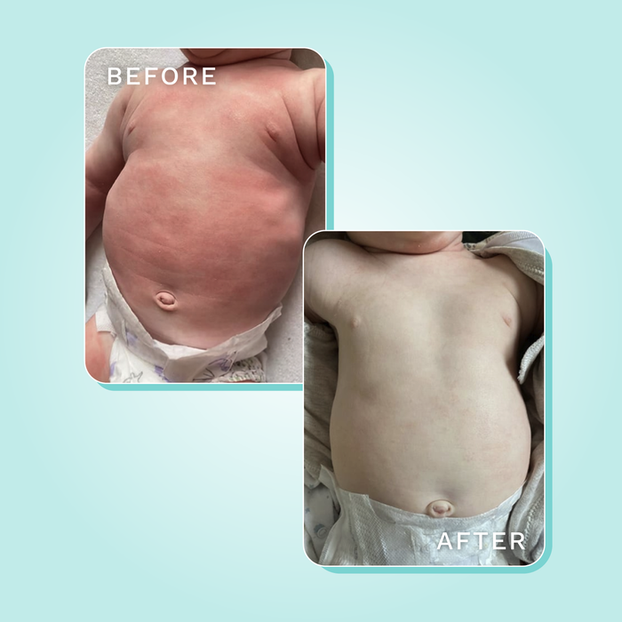 Dreamskin eczema baby bodysuit before and after comparison