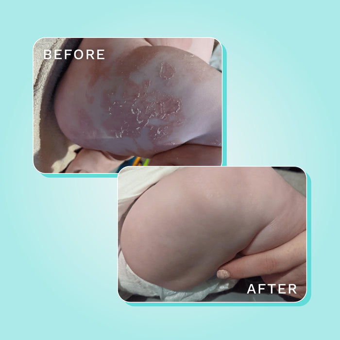 Dreamskin eczema baby leggings before and after comparison