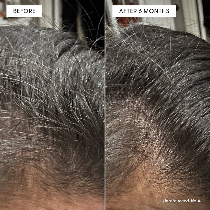 Close-up comparison of a person’s scalp before and after 6 months of using The Shower Duo by Arey, showing increased hair density and coverage on the right side. Designed for those seeking in-shower hair care, the results demonstrate healthier hair over time. Text states Unretouched. No AI.